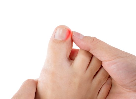 Ingrown,Toenails,On,A,Woman's,Foot,,Isolated,On,White,Background,
